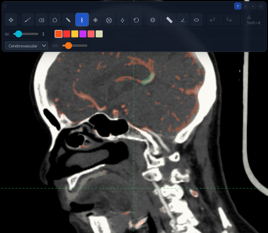Spwig Medical Viewer annotation toolbar with vessel labels and keyboard-driven tools