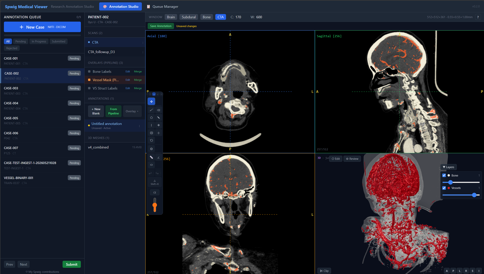 Same quadview after pre-annotation — vessels detected across all four panes, 3D vessel mesh rendered