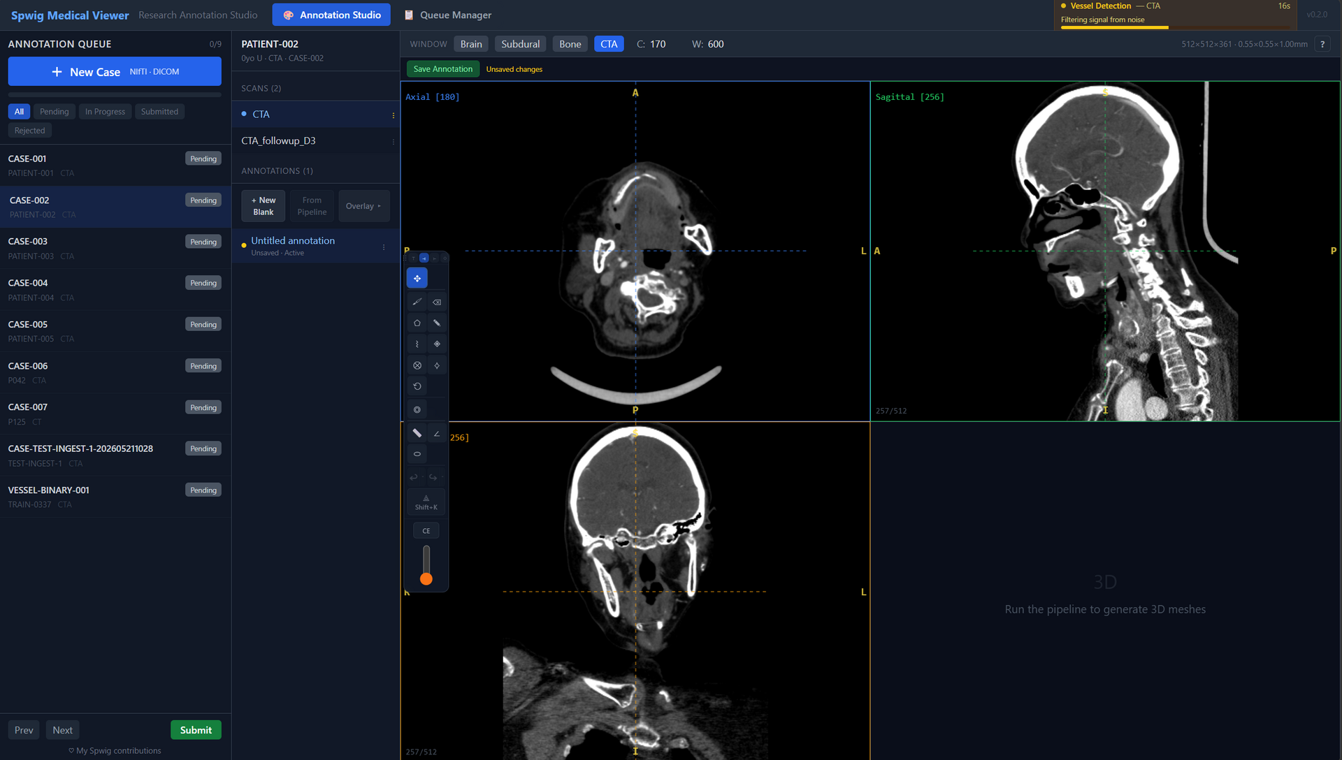 Quadview before running the pre-annotation pipeline — empty 3D pane, raw CT slices in 2D